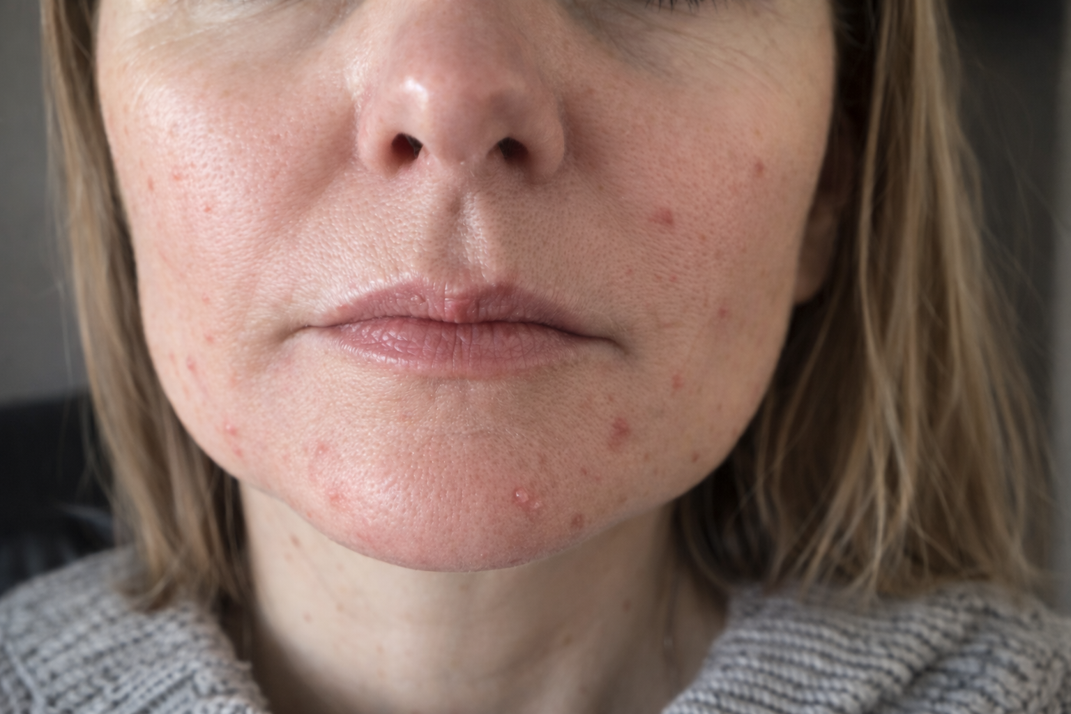 Close-up of a person's face with visible acne on a neutral background